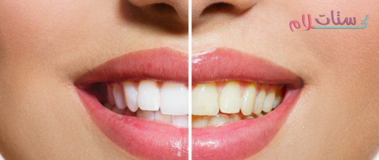 وصفات لتبييض الأسنان