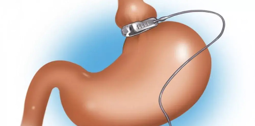 مشبك المعدة