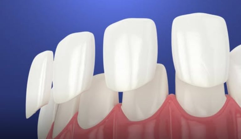 القشرة التجميلية للأسنان